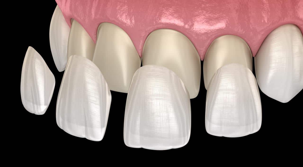 Porcelain Veneers Near Me