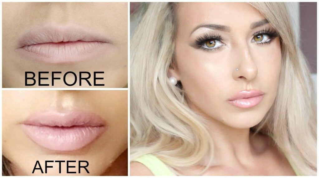 Juvederm Lips Near Me