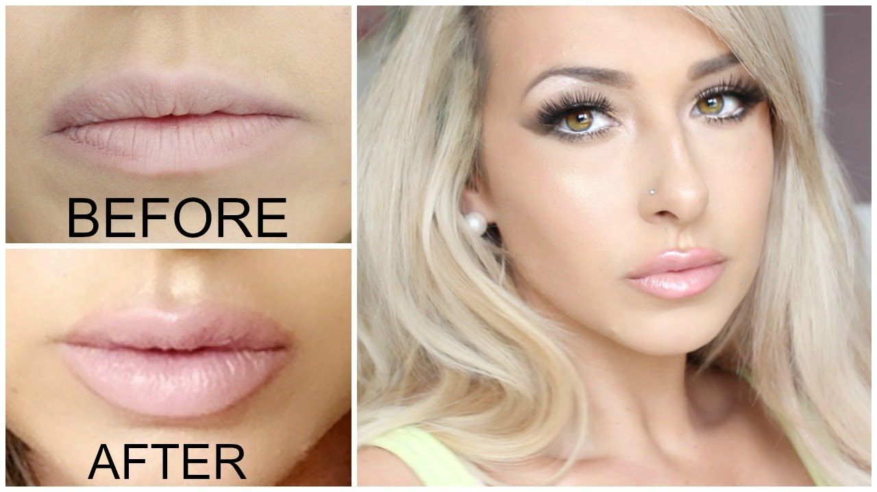 Juvederm Lips Near Me