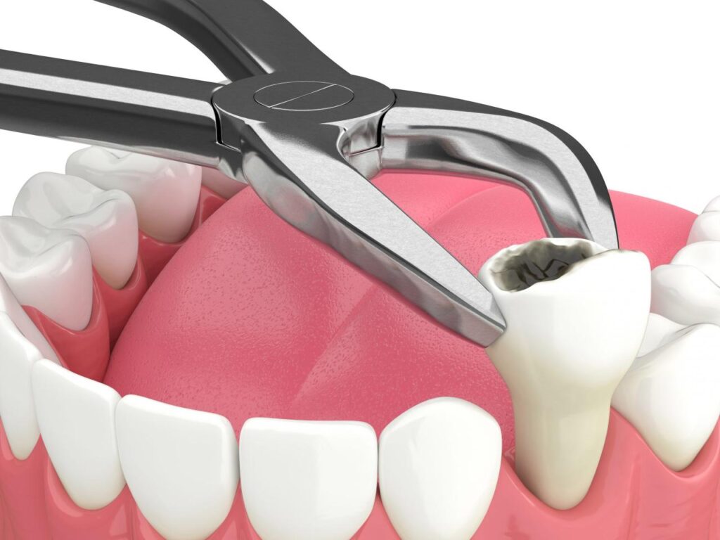 Tooth Extractions Near Me