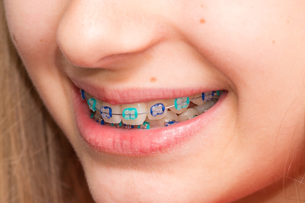 Kids Orthodontist Near Me