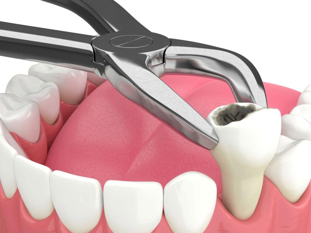 Tooth Extraction Near Me